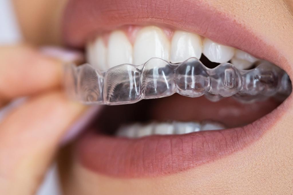 Clear aligner tray on teeth